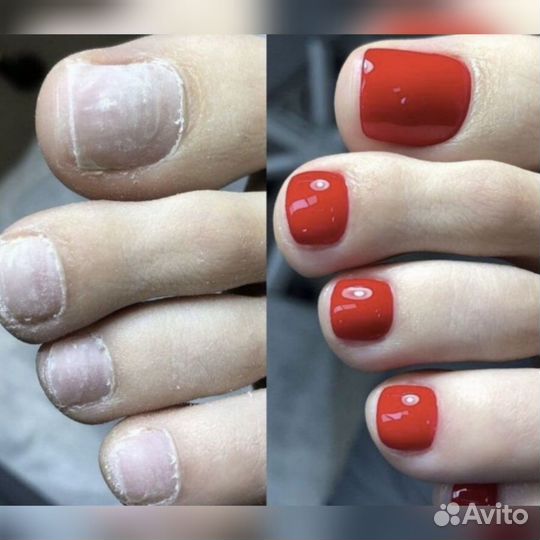 Педикюр, Смарт-Педикюр