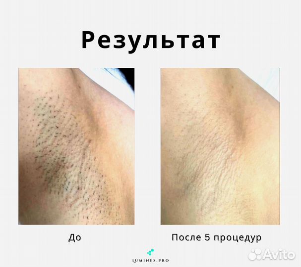 Аппарат для эпиляции Люминес максван 1200вт