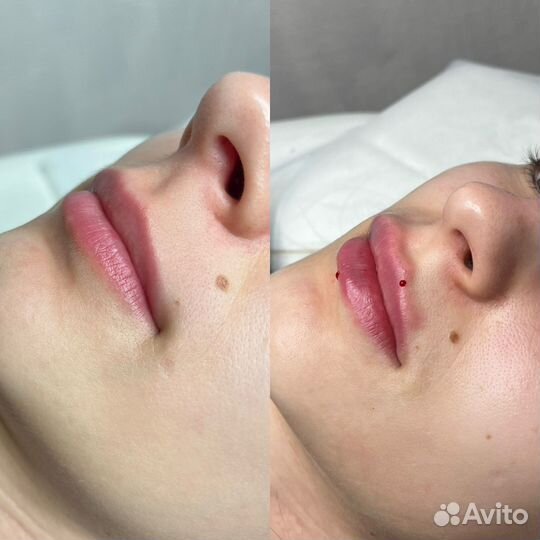 Увеличение губ