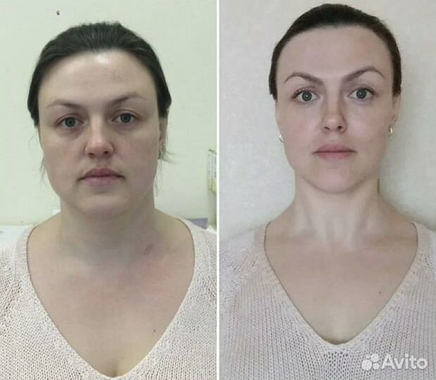 Массаж ручной антицеллюлитный и лимфодренажный