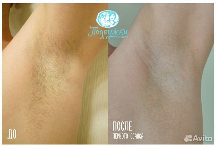 Лазерная эпиляция Санкт-Петербург