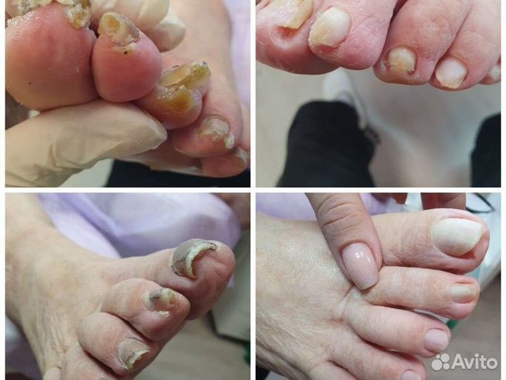 Педикюр всех видов