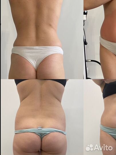 Жиротоп микровейв/похудение/коррекция фигуры