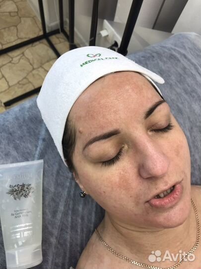 Гигиеническая чистка лица