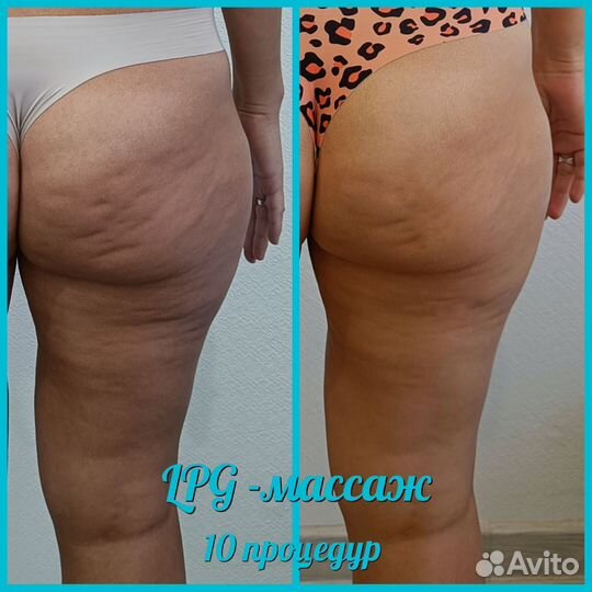 LPG массаж