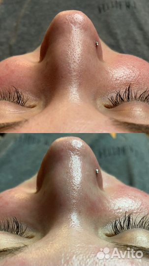 Косметолог/Чистка лица/Пилинги/Био/Мезо