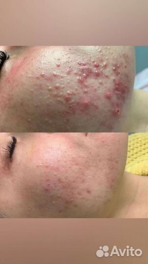 Карбокситерапия (газовые уколы)