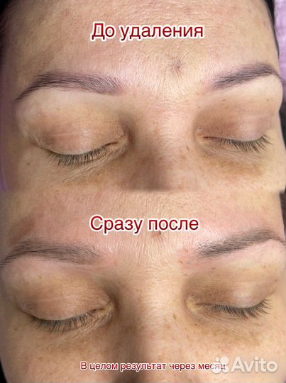 Удаление татуажа лазером