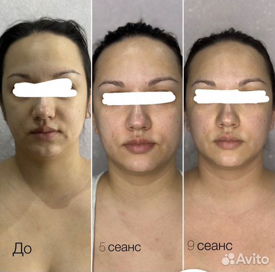 Карбокситерапия