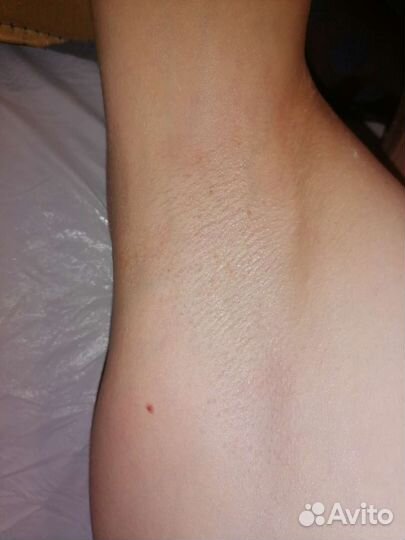 Депиляция(эпиляция) сахаром. Шугаринг в роще