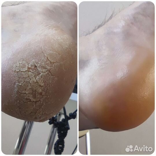 Педикюр Подолог