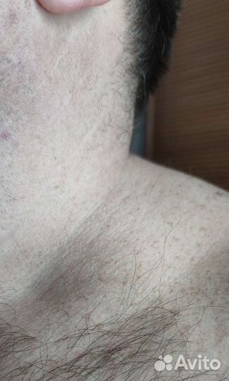 Удаление папиллом, бородавок