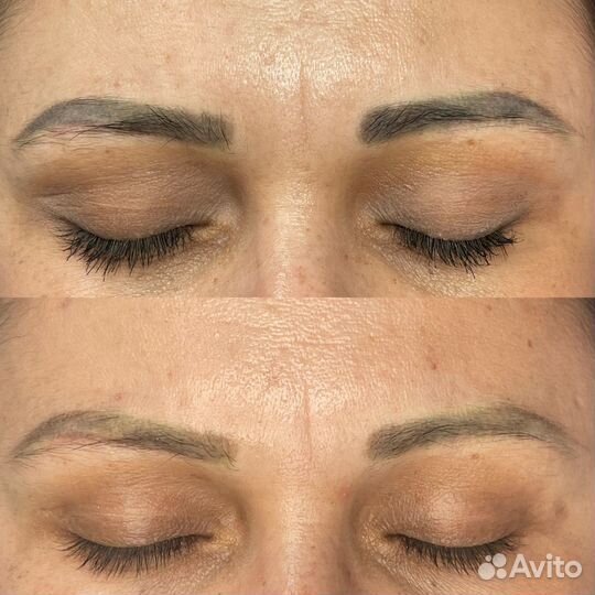 Удаление татуажа и тату лазером и ремувером