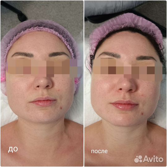 Массаж лица