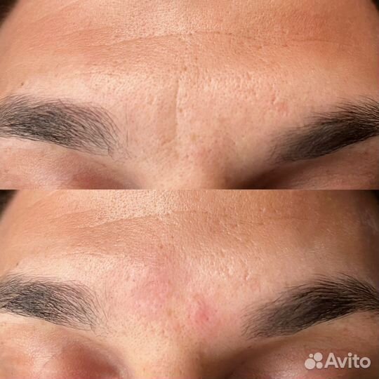 Биоревитализация