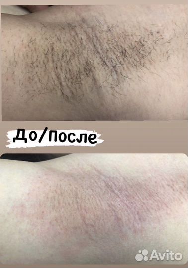 Электроэпиляция
