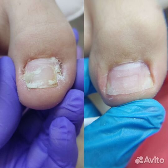 Педикюр, подолог