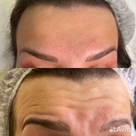 Ботулинотерапия модели