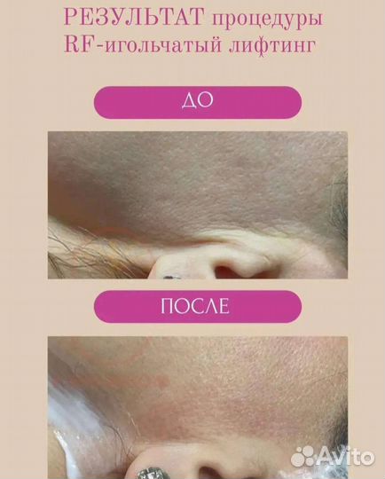Rf игольчатый аппаратное омоложение в СПБ
