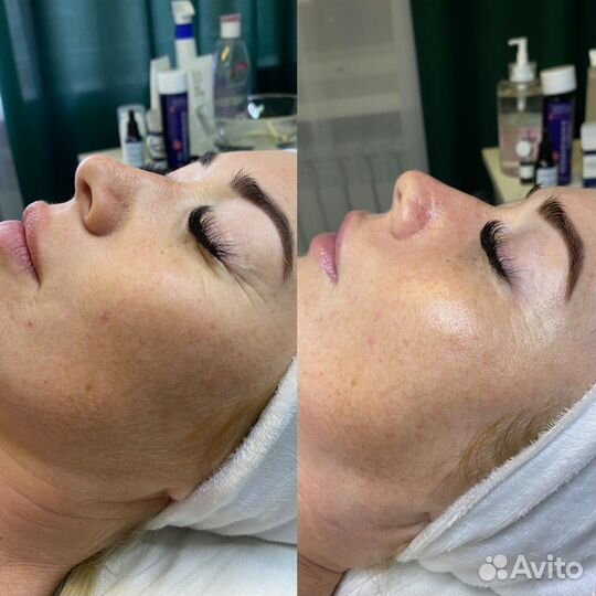 УЗ чистка,Кавитация, вакуумный массаж, рф-лифтинг