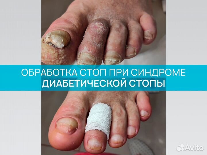 Подолог, медицинский педикюр при сдс, обработка