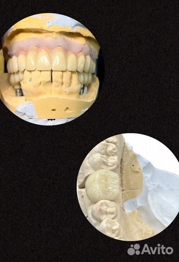 Зубные протезы