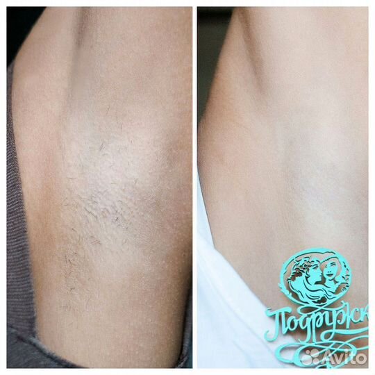 Лазерная эпиляция Санкт-Петербург