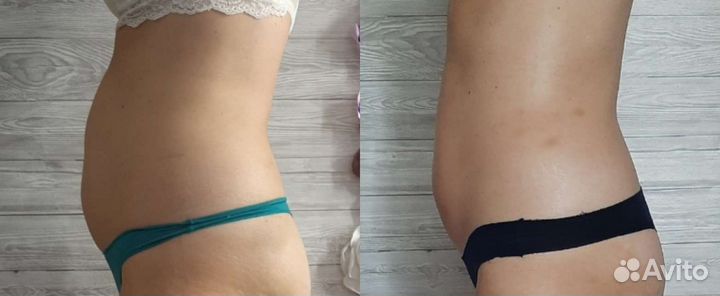 Антицеллюлитный массаж