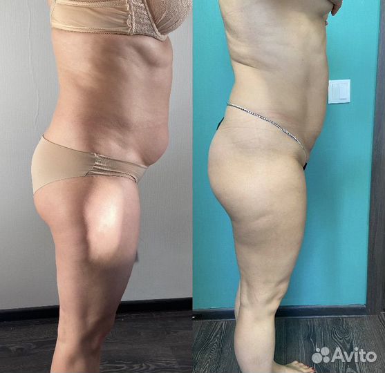 LPG массаж тела и лица. Ручной массаж. Медовый