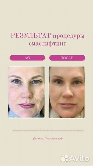 Контурная пластика