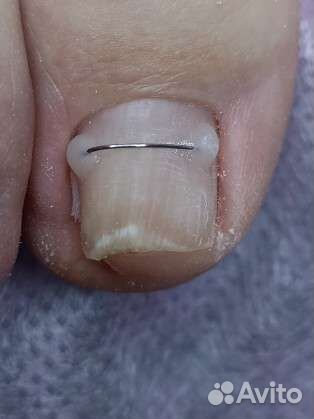 Установка титановой нити