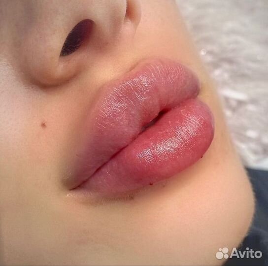 Увеличение губ. Профиль Джоли. Косметология