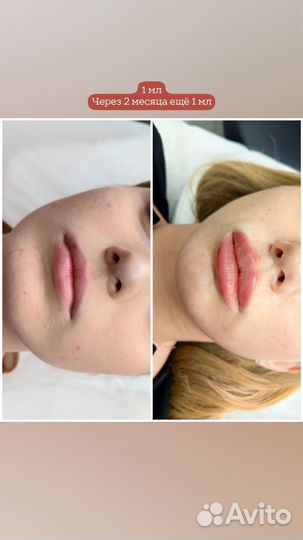 Увеличение губ