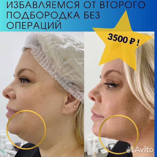 SMAS лифтинг,Пилинги,Rf микроигольчатый, Липосоник