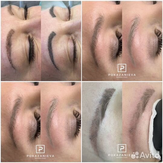 Удаление тату, татуажа бровей губ глаз