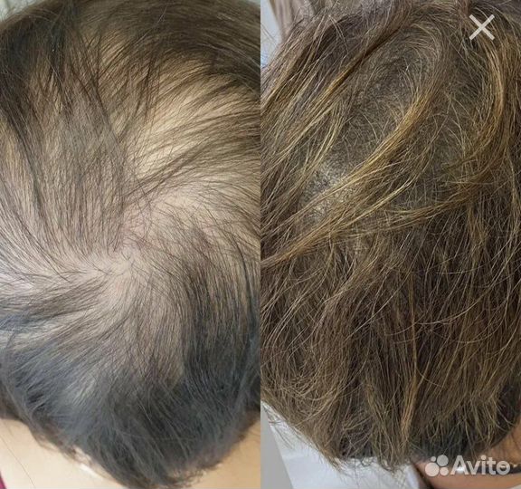 Трихопигментация