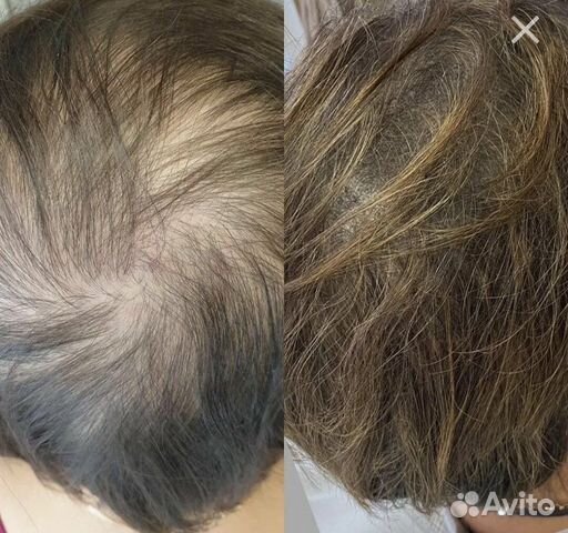 Трихопигментация