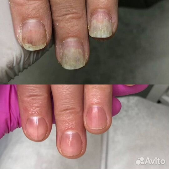 Подолог, вросший ноготь, мозоли