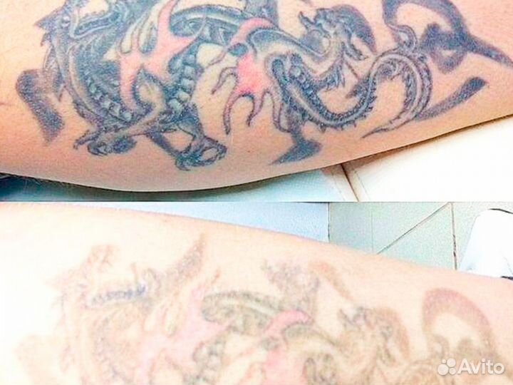 Удаление татуировок и татуажа