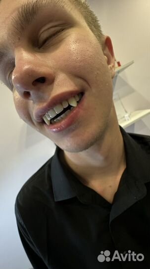 Наращивание клыков