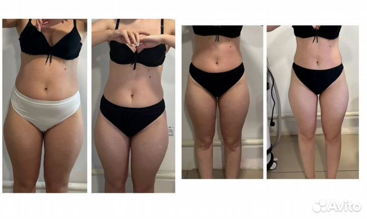 LPG массаж в Перми Оригинальный бразильский LPG