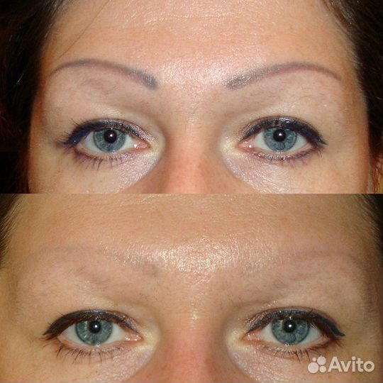 Лазерное удаление татуажа, тату