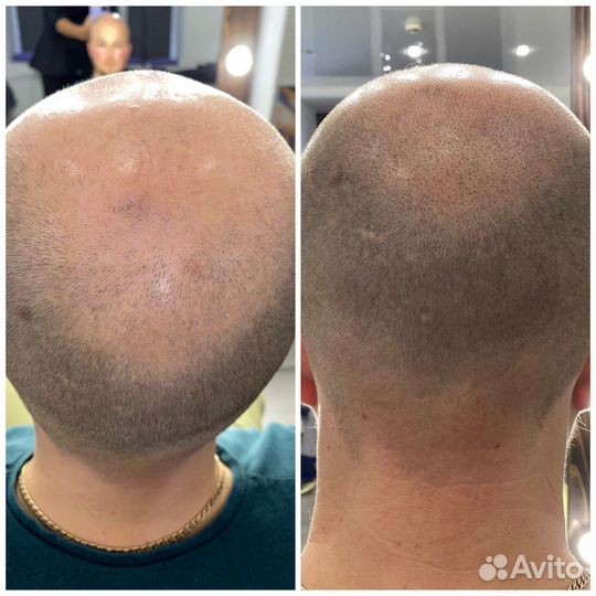 Трихопигментация по методу SMP