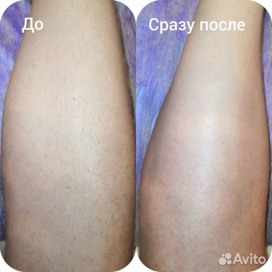 Депиляция воском: верхняя губа