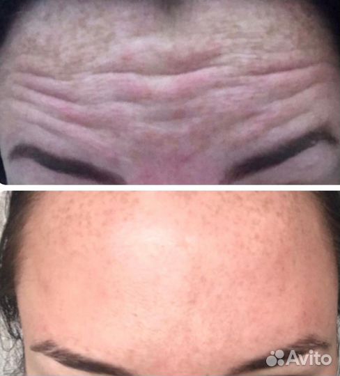 Ботокс лица