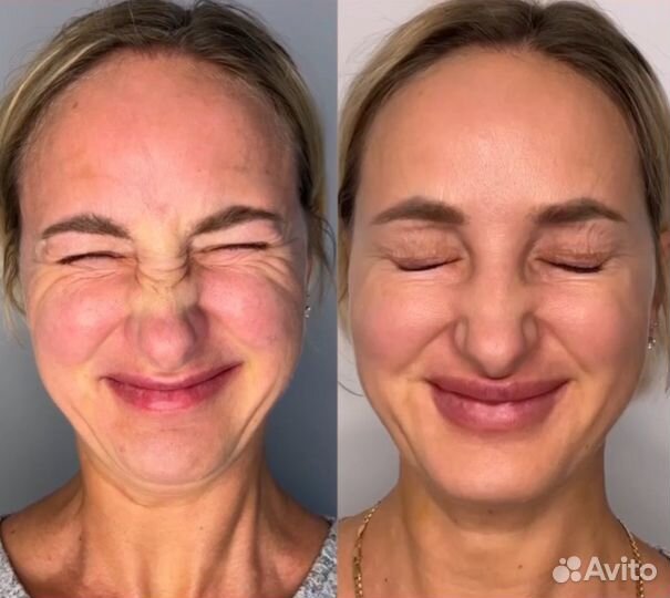 FullFace Botox