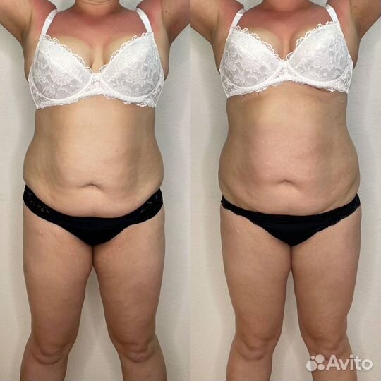 Антицеллюлитный массаж, массаж лица