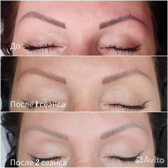 Лазерное удаление татуажа