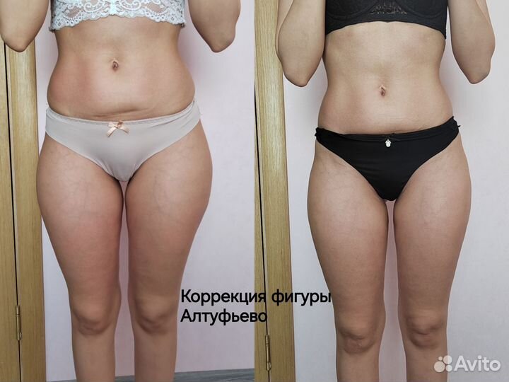 Коррекция Фигуры Массаж RF лифтинг