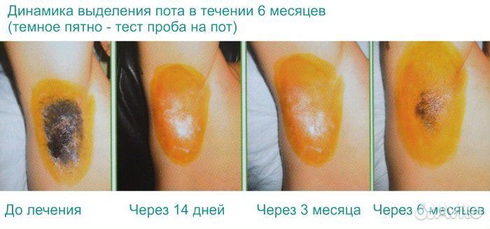 Модели на ботокс лица,увеличение губ